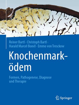 cover image of Knochenmarködem